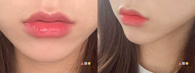 หลังทำหัตถการ