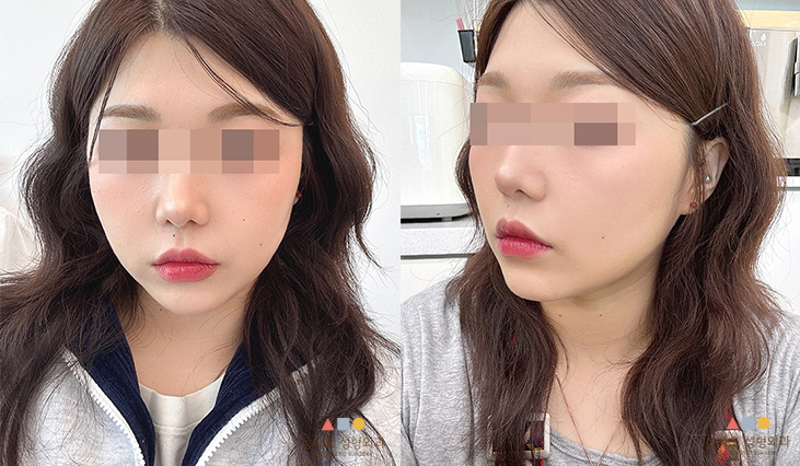 หลังทำหัตถการ