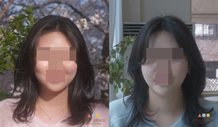 หลังทำหัตถการ