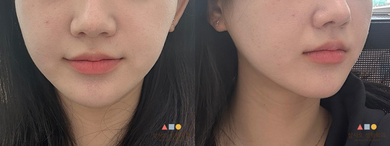 หลังทำหัตถการ