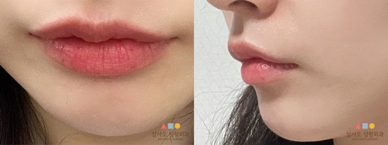 ก่อนทำหัตถการ