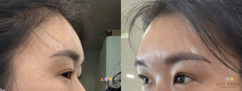 หลังทำหัตถการ