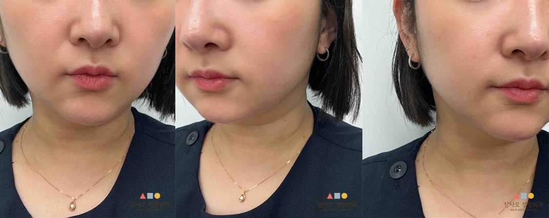 หลังทำหัตถการ