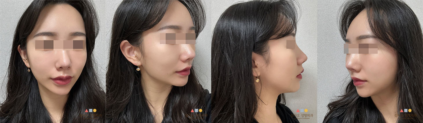 หลังทำหัตถการ