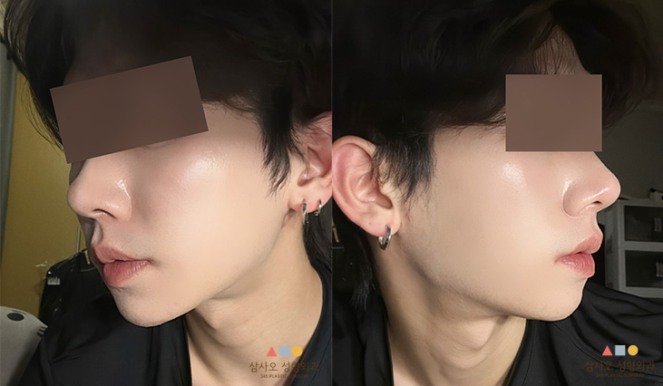 หลังทำหัตถการ