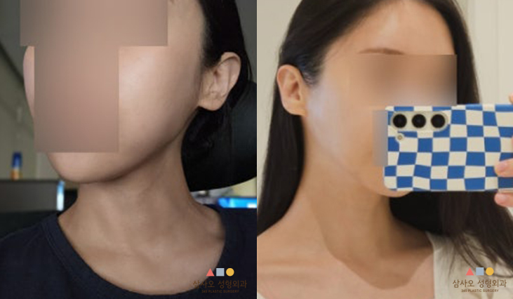 หลังทำหัตถการ